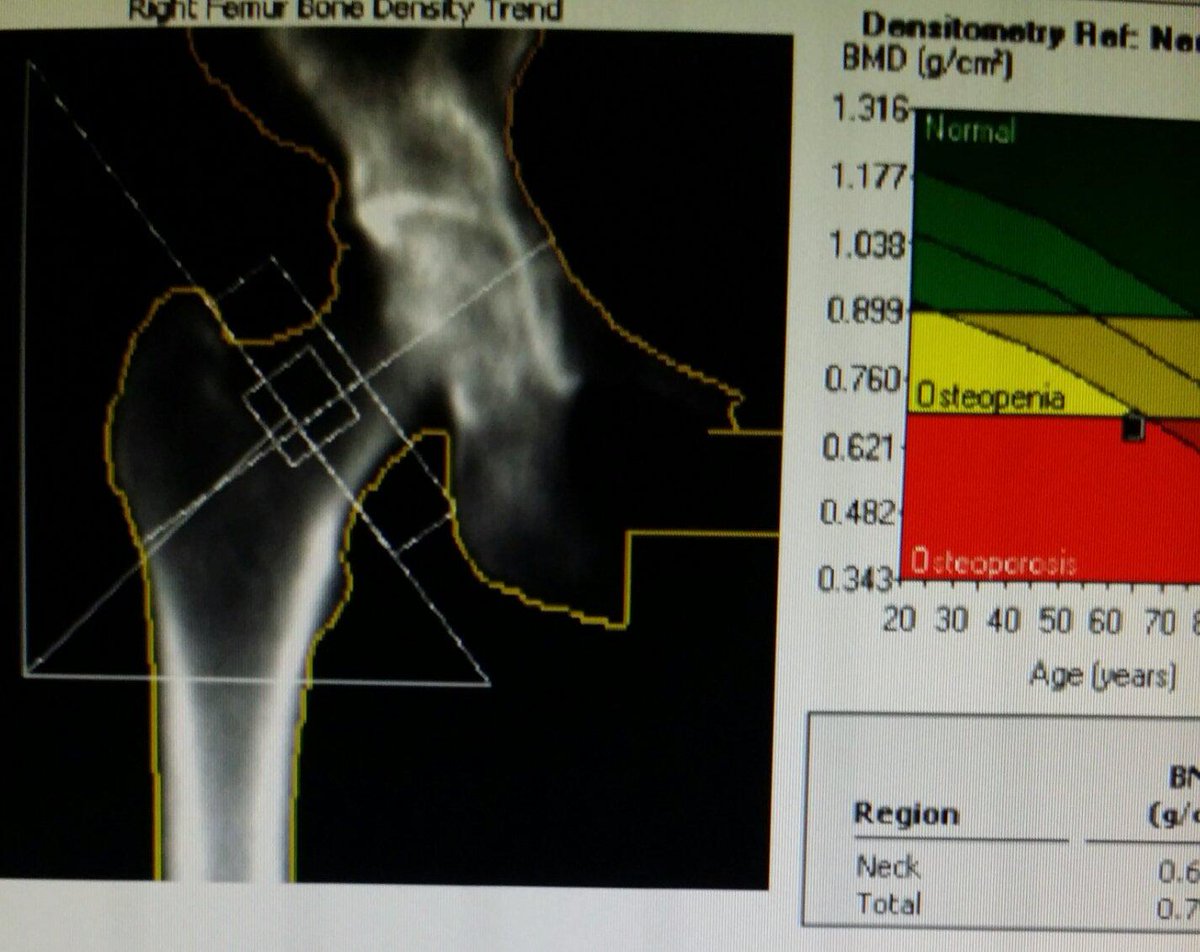 steleRAD's tweet image. #Bone #densitometry. Very low #xray #radiation measures bone mineral density to assess #osteoporosis &amp;amp; #fracture risk