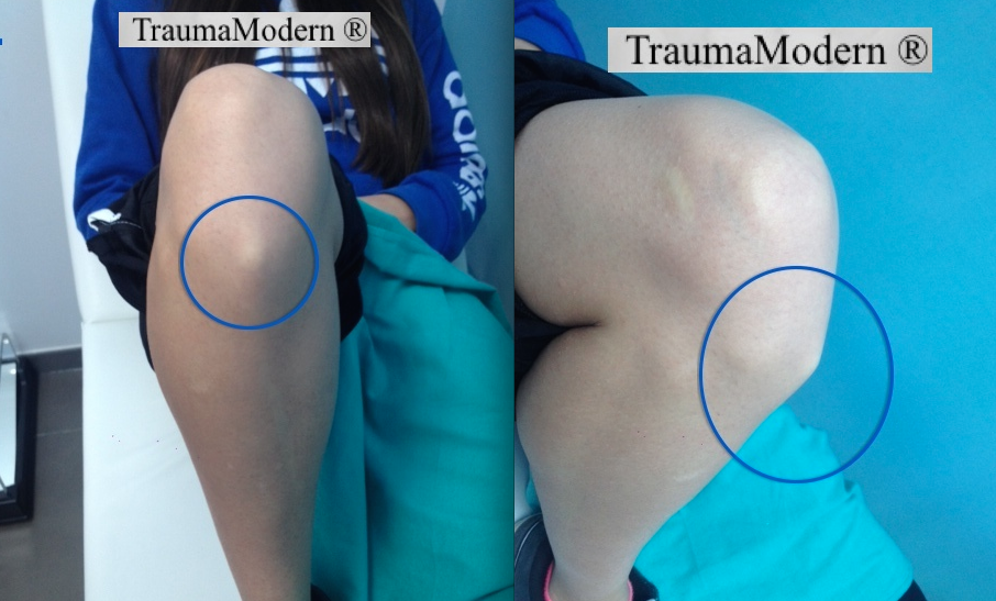 trauma_modern's tweet image. Secuela de Osgood Schlatter: tuberosidad tibial anterior irregular y prominente en adulto de 21 años