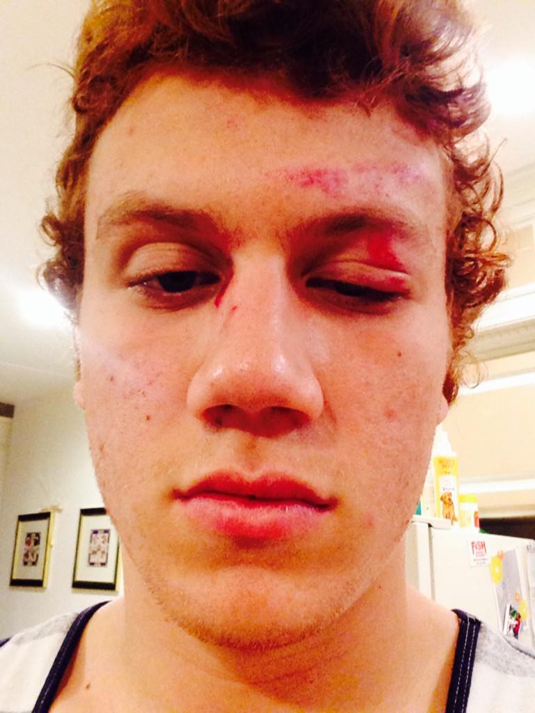 When a volleyball net cuts your eye open #gainz
