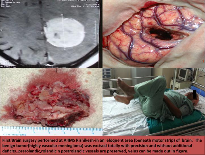 aiimsrishikesh's tweet photo. First Brain surgery,a benign tumor(highly vascular meningioma) was excised totally without deficits at AIIMS Rishikes http://t.co/lLVnB6LPb7