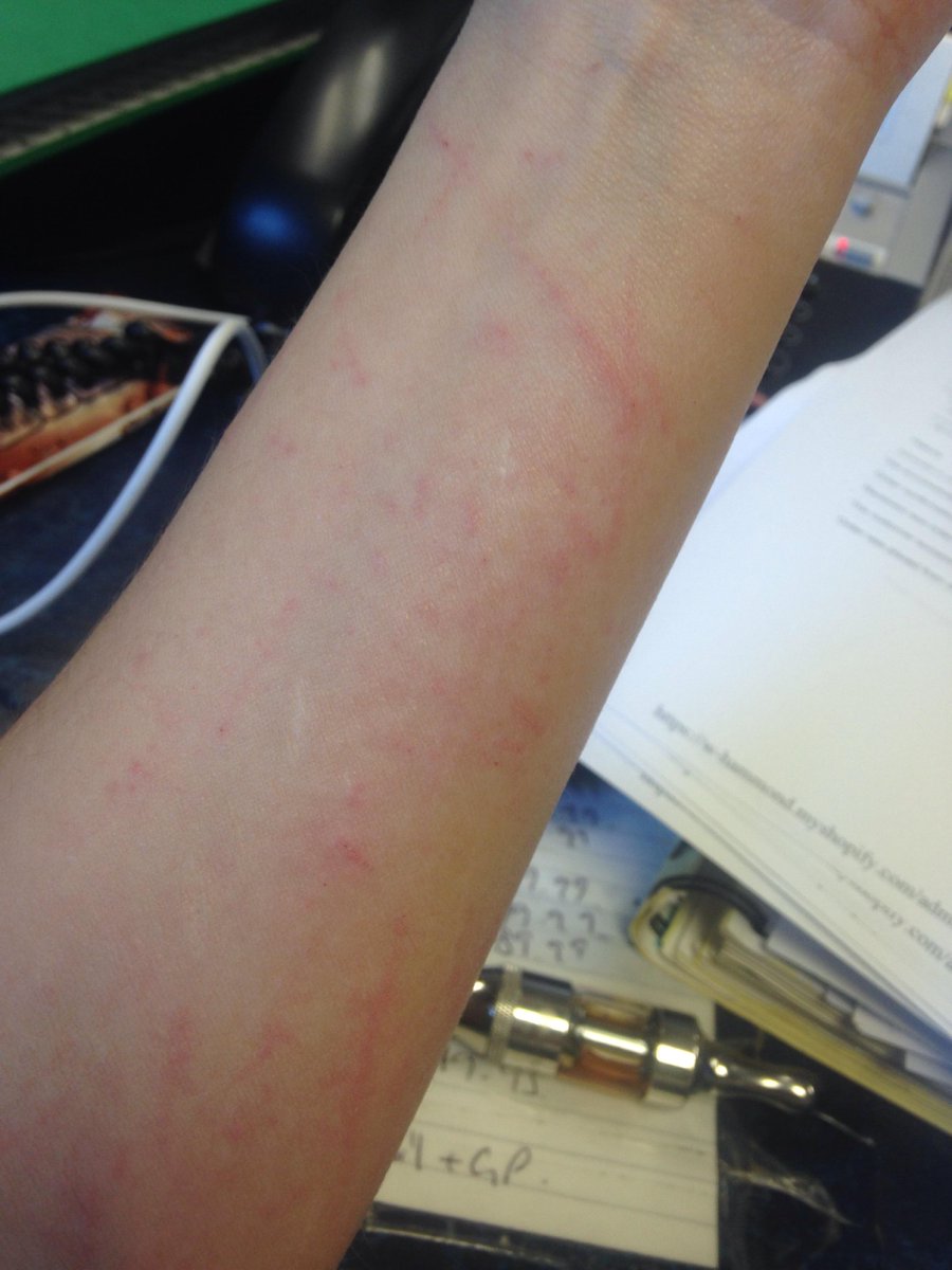 ooohjebus's tweet image. @ASOS_HeretoHelp bought a lovely dress from you &amp;amp; after 1 nyt of wearing it have arms covered in painful scratches!