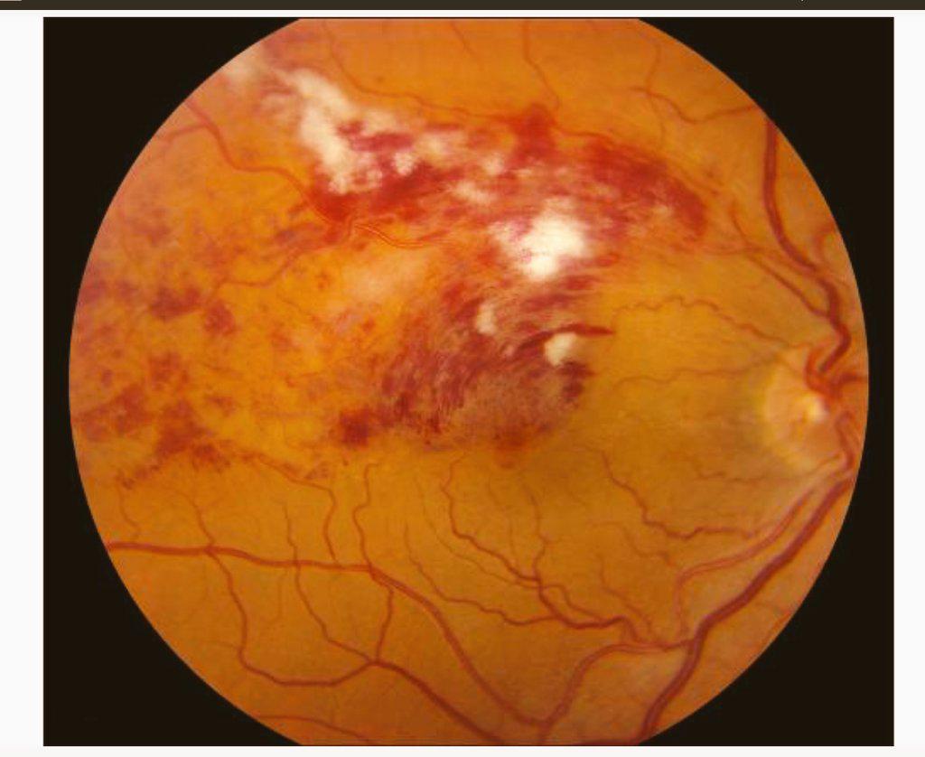 Eye_Atlas's tweet image. #BRVO, Branch Retinal Vein Occlusion
Flame Hemorrhage, dot/blot hge.
Cotton wool spots
Superotemporal arcade