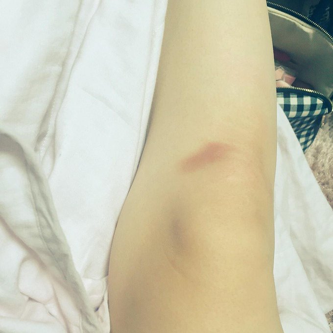 半身浴。 足がこんなことになった、 http://t.co/UBd7DdTqFJ