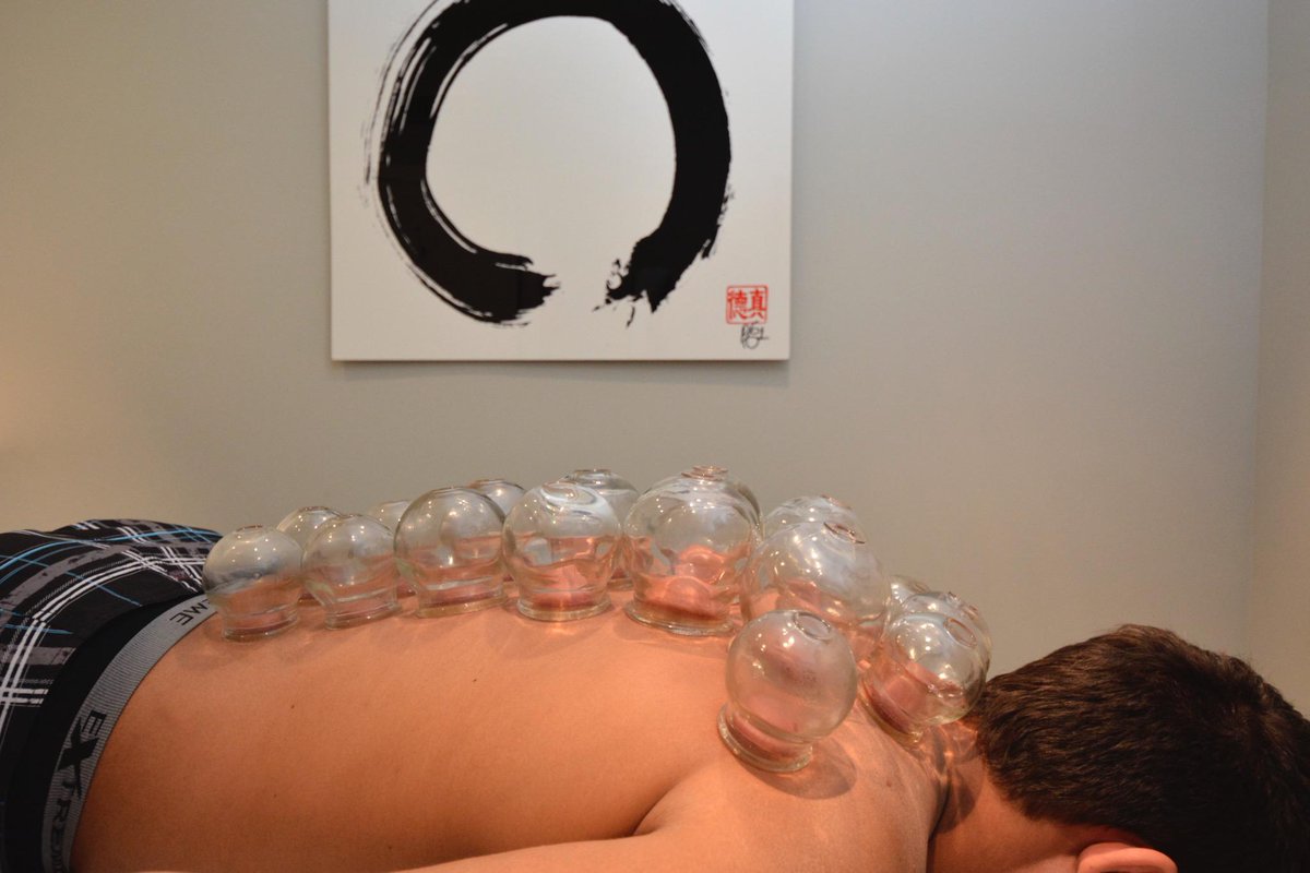 AcupunctureZen's tweet photo. http://t.co/7kOdETC9St
Check out the benefits of fire cupping in the link above #FireCups #FireCupping #TCM #Cups http://t.co/3fz4LhhdTi