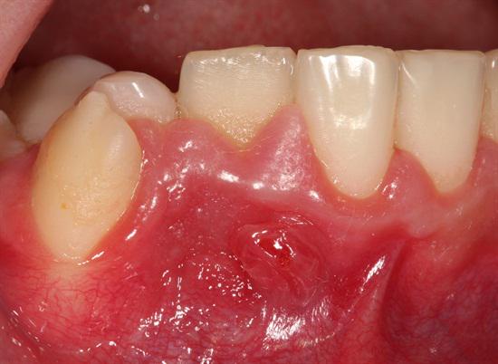 HowardFarran's tweet photo. Dens in dente and necrosis of a lateral incisor
http://t.co/MtLpcFMfyd
#DensInDente #ToothWithinATooth #Dentistry http://t.co/1aapo2gz6C