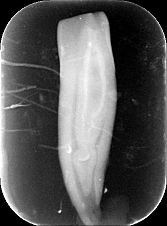 HowardFarran's tweet photo. Dens in dente and necrosis of a lateral incisor
http://t.co/MtLpcFMfyd
#DensInDente #ToothWithinATooth #Dentistry http://t.co/1aapo2gz6C