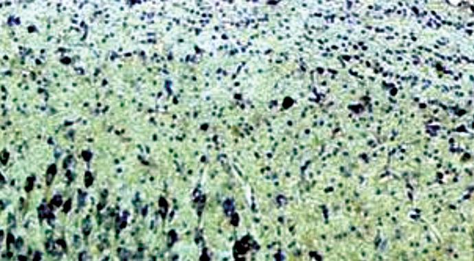CleClinicMD's tweet photo. #Study explores how chronic #hydrocephalus is accompanied by high levels of cognitive function http://t.co/ykXyo7S2N3 http://t.co/wvofsnxIxg