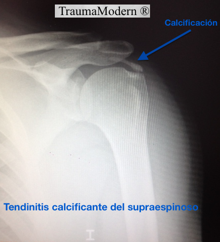 trauma_modern's tweet photo. Radiografía de tendinitis calcificante del supraespinoso. TraumaModern&amp;DoctorLara http://t.co/jUksrcqKlo