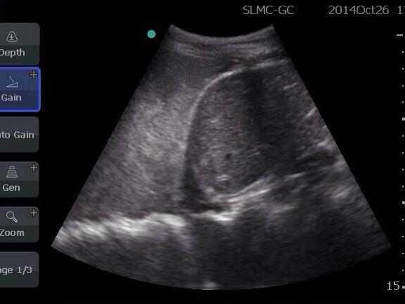 EM_RESUS's tweet photo. FAST: Spine normally not seen above diaphragm! #SpineSign MT @docjon75 HEMOTHORAX: no anechoic fluid,but mixed echos! http://t.co/KwwyaV9ctf