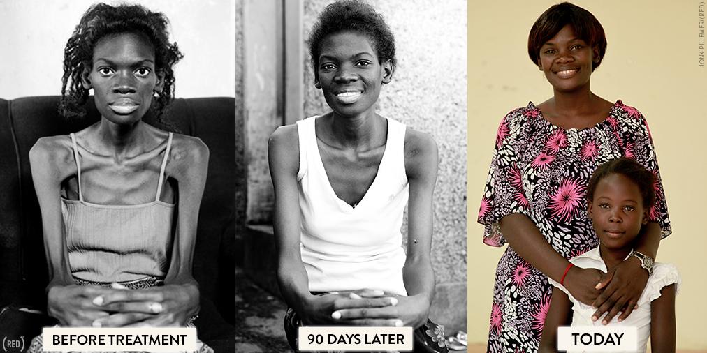 Hiv Patient Before And After