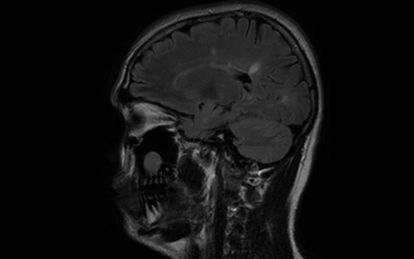 Un nuevo #biomarcador predice la respuesta al tratamiento de la #EsclerosisMúltiple consalud.es/see_news.php?i… #médicos