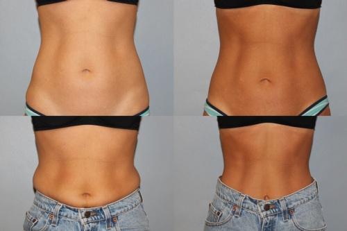 coolsculpting before after coolsculpting before after