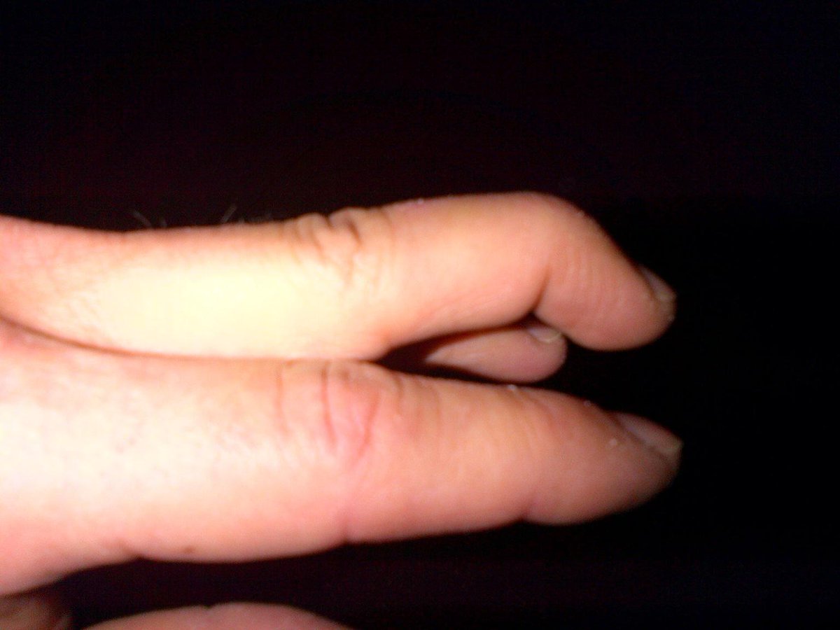 RickLeventhal's tweet photo. Snapped tendon in my fingertip playing basketball. Still hit a couple 3's but we lost in OT #oldage #stuffbreaks http://t.co/VWJGaZvyb6
