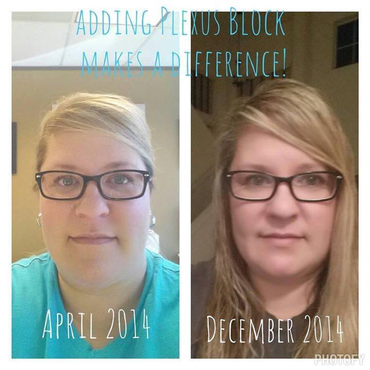 KarenCTucker's tweet image. Love seeing Rachael&apos;s transformation! She says &quot;My smile@is starting to look like I remember!!&quot; #plexuschangeslives