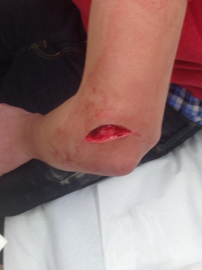 AuzzLoewen08's tweet photo. Thanks @Joyfulls02 #12stitches http://t.co/HSUH9luk8Y
