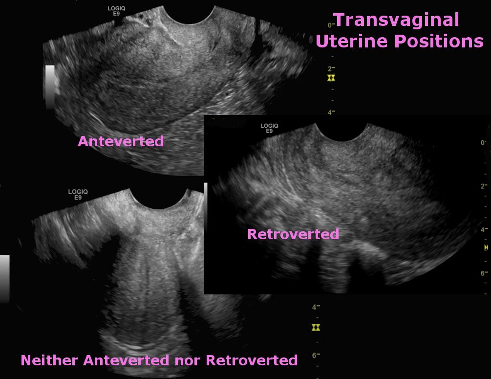 Uterus Ultrasound Transvaginal