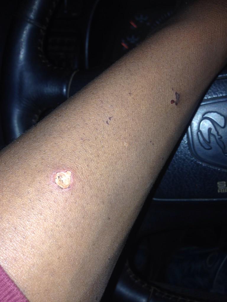 TavionMurphy's tweet photo. It wouldn't surprise me if I get skin cancer by the age of 30 #weldingproblems http://t.co/9FScihBosP