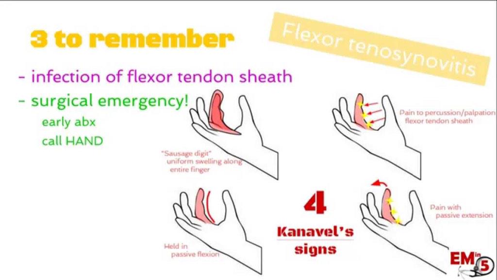 AlamoCityEM's tweet photo. Flexor Tenosynovitis:
Circumferential Swelling
Held in flexion
TTP over tendon
Pain w/extension
Via @ABargren
#FOAMed http://t.co/zjqkjugfFO