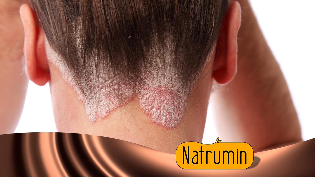 Saç Derinizde Sivilce,kaşıntı mı Var? Natrumin ile ilk kullanımdan itibaren kurtulabilirsiniz. natrumin.com.tr/neden-natrumin/