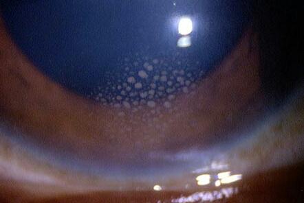 Eye_Atlas's tweet photo. Mutton-fat #keratic #precipitates forming an Arlt's triangle in a wedge-shaped region in granulomatous #uveitis http://t.co/Ssu4CHdZ2p