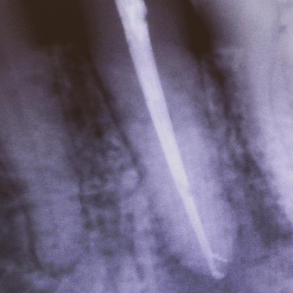 GloVargasM's tweet image. Vuelve a ser viernes! #ProtaperNext #Endodoncia