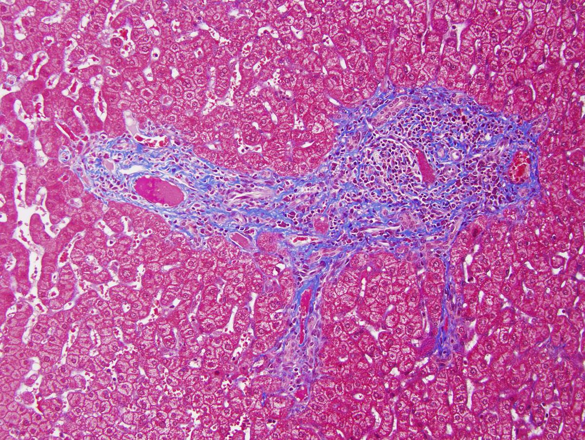 Hopkins_GI_Path's tweet photo. The empire is invading the liver.  #trichrome #pathologists #hoth http://t.co/09OHT2jqZx
