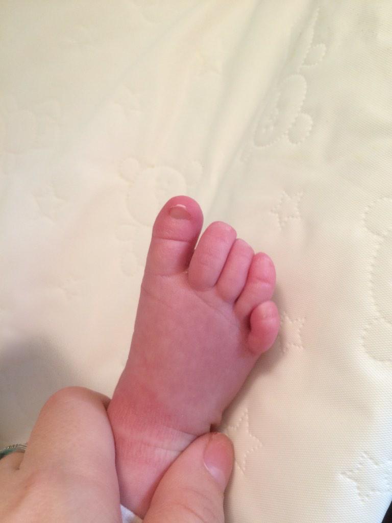 Lol poor girl has her daddy's feet. #crookedtoe #babyfeet #cutelittlethings #loveher