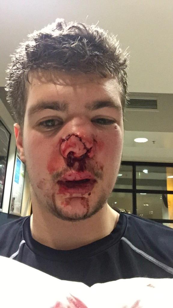 Cooper_prechel's tweet photo. Shout out to Schaber for being a warrior. http://t.co/nmyLqQ5rdT