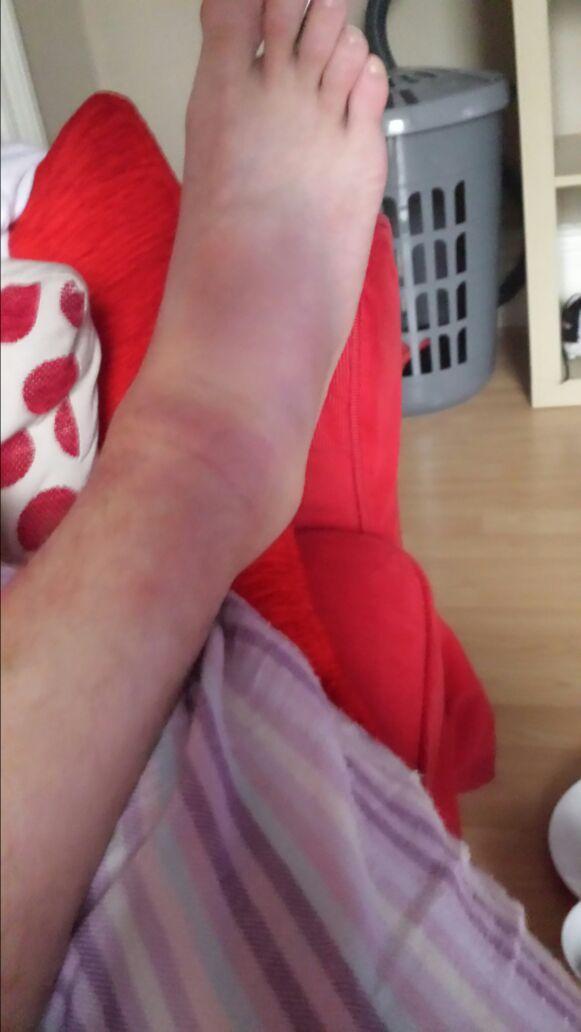 darrellsykes85's tweet photo. Cheers Donncaster Deaf TFC great 3pts :) got bad injury :/ http://t.co/BnclyOE8Jg