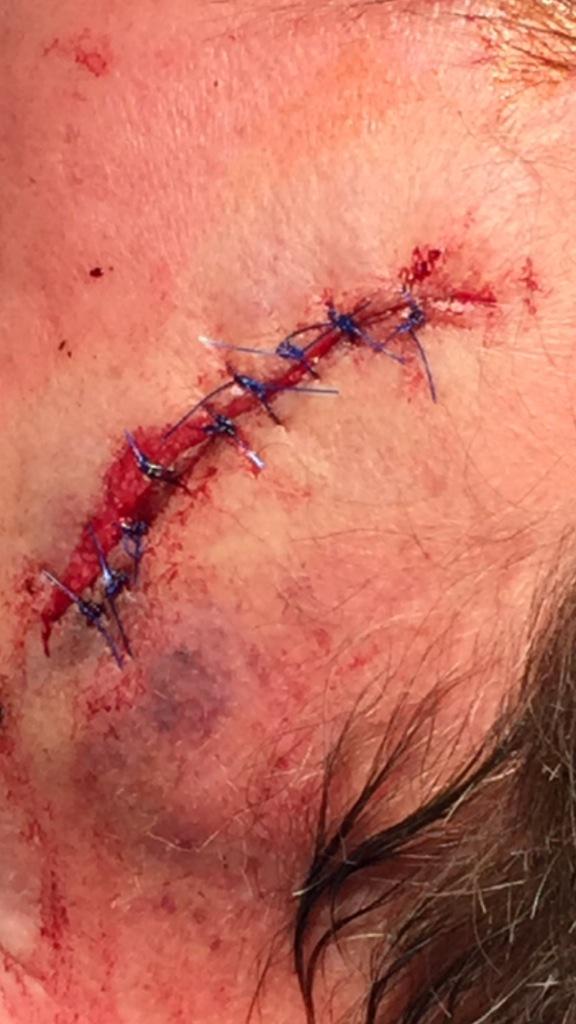 MedicalPorn's tweet photo. The first set of sutures I've ever done. Motor vehicle accident caused this gash in his forehead. http://t.co/tqvyqnPVUT