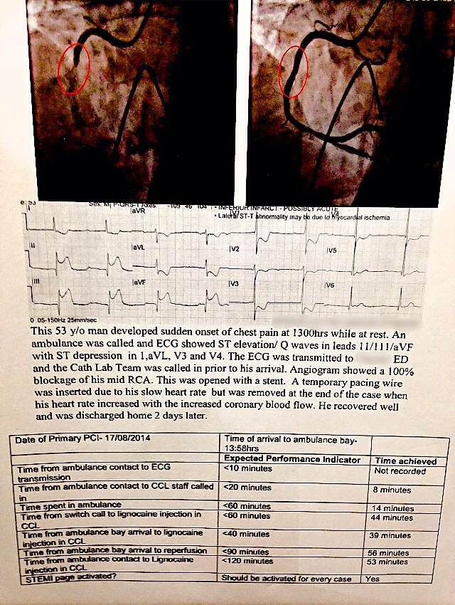 EMS_Junkie's tweet image. #CodeStemi case review of 100% blockage of RCA. @paramedic_al #FOAMems #FOAMed