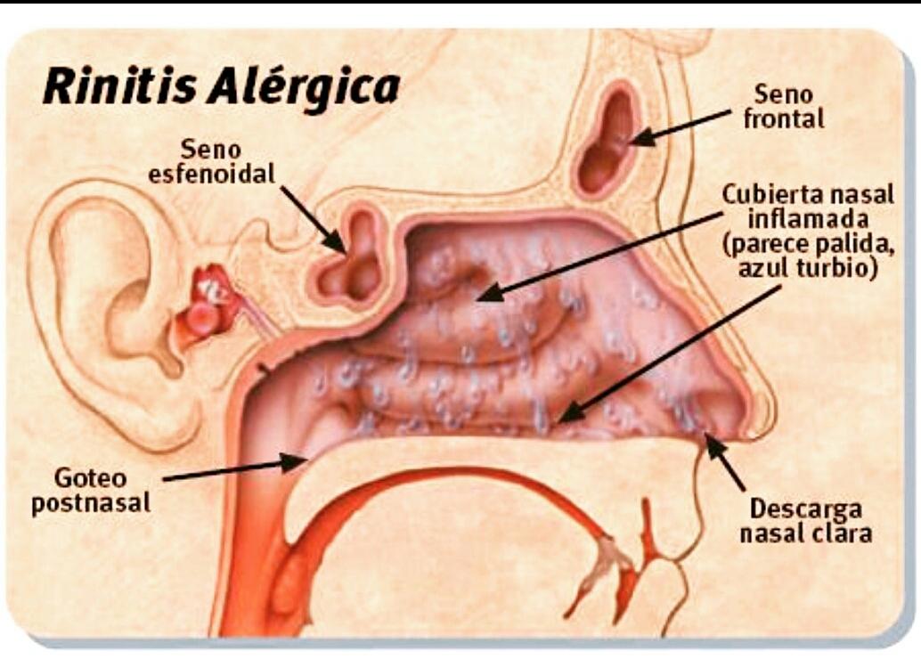 EnfermeriaAux's tweet photo. #RinitisAlergica http://t.co/72rn6AOYkW