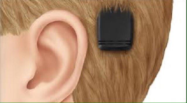 костный слуховой. слуховой аппарат костной проводимости ponto plus. имплантируемый слуховой аппарат костной проводимости. костный слуховой. костный имплант среднего уха baha система.