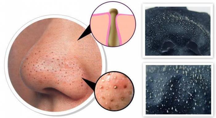 endogall's tweet image. Akne,sivilce,cilt lekeleri,siyah noktalar güneş lekeleri için siyah maske! İlk kullanımda etki
siyahmaske.com