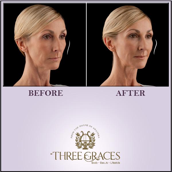 ThreeGracesIn's tweet photo. Restore volume &amp; fullness in your face with Dermal filler #treatment. Reduce the fine lines &amp; give it a lift! http://t.co/d5vnTCrjnO