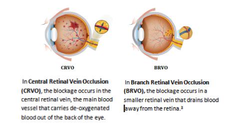 Regeneron's tweet image. There are 2 types of #RVO: #CRVO and #BRVO. BRVO is more common, but CRVO generally is most sig. threat to vision
