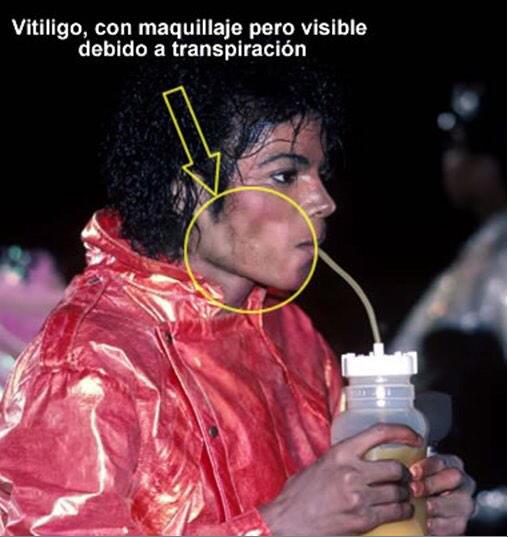 外薗昌也 鬼畜島 パンプキンナイト 闇異本 犬神連載中 Mtvのマイケル ジャクソンpv特集見てる Http T Co Cazzvyzpjl マイケルが白くなったのは整形などではなく 尋常性白斑及び全身性エリテマトーデスという病気の為だった 若い頃から発症しムラになっ