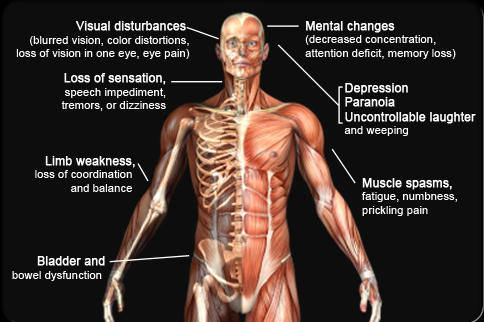 THEMMEXCHANGE's tweet photo. Marijuana can alleviate MS symptoms 

http://t.co/ncH4DGhgV4
#Ms #marijuana #cannabis #health #multiplesclerosis http://t.co/mInpaeF36D
