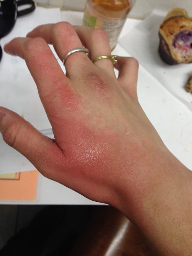 bbennettxoxo's tweet photo. here we go again😭😭😭 #samehand http://t.co/5QxnsVapD3