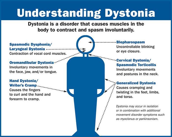 expert's suggestion on treatment of dystonia muscle spasm 
