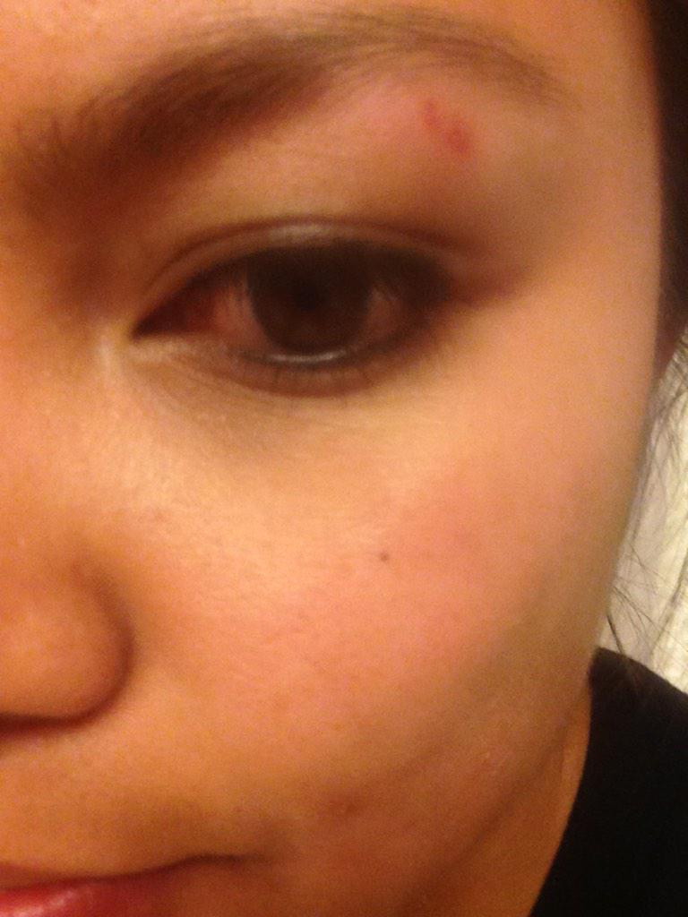 marissamber20's tweet photo. Look at the shiner I got too #roughday #ballislyfe #JAX2014 @brettdeannie http://t.co/sbgAQ7ayF2