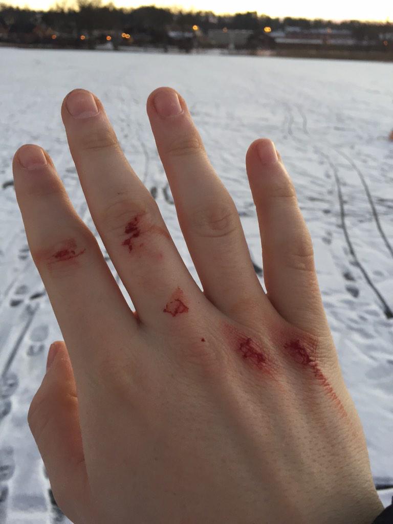Alolbob1non's tweet photo. Det gör ont att lira hockey mot mig. #brunker #amputation http://t.co/lZ2Vus5q2p