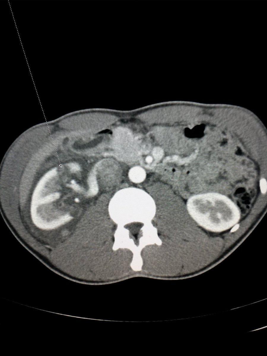 NBRadiologists's tweet photo. #Multislice #CT shows a #fracture of the #kidney. The patient fell off his #bike. #radiologist #radiology http://t.co/nUT8eksFGz