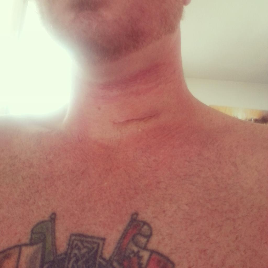 KevyBhoy79's tweet photo. Heres to #2015.Had a painful 2 years till #Feb28 2014 when i had surgery to fix my #pinchednerve #C6C7 #DrIzukawa. http://t.co/jujaeoxPkl
