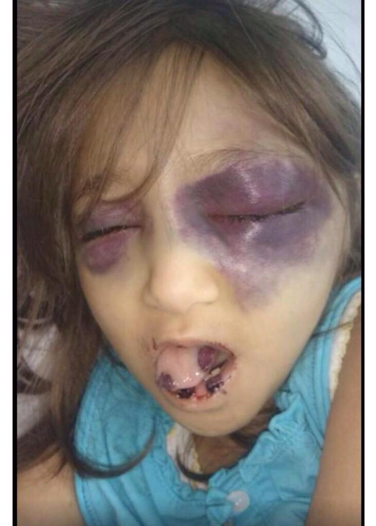 AJELNEWS24's tweet photo. #صورة مؤلمة للطفلة "لميس" التي تحتاج لإحالة لمستشفى الملك فيصل لكي تزرع نخاعاً في العظم!

#لميس_بحاجة_أمر_ملكي
- http://t.co/J3cTqtBnhk