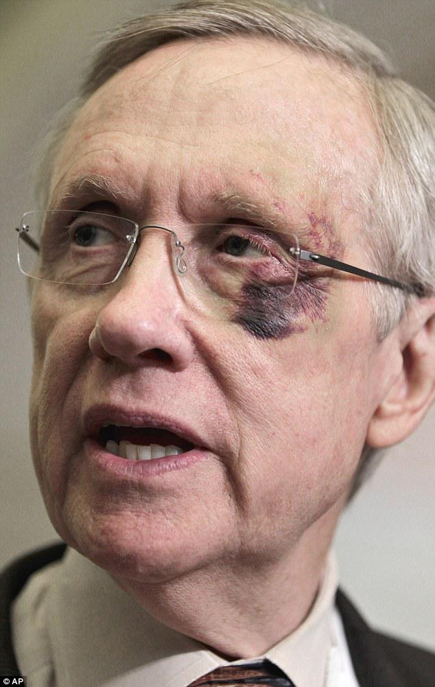 Harry Reid in hospital with broken ribs, facial bones