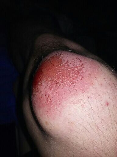 EruptSwift's tweet photo. Having the worst night and morning so far. This hurts so bad http://t.co/gMgx11w27t