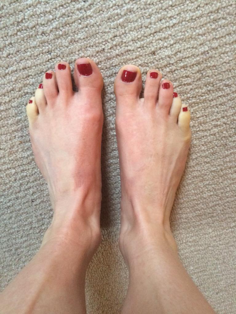 Lipstick_Runner's tweet image. Marshalled at Regents Park 10k. Lost the feeling in my toes. So much so they went white! #cannotwalk #painful