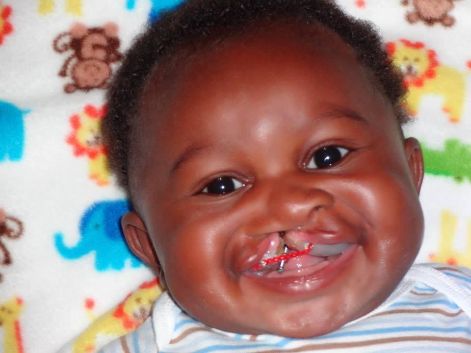 David before surgery