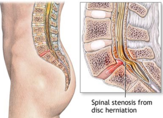 getadjusted's tweet image. What are the Most Common #SpinalDisc Problems? bit.ly/14pq6Do